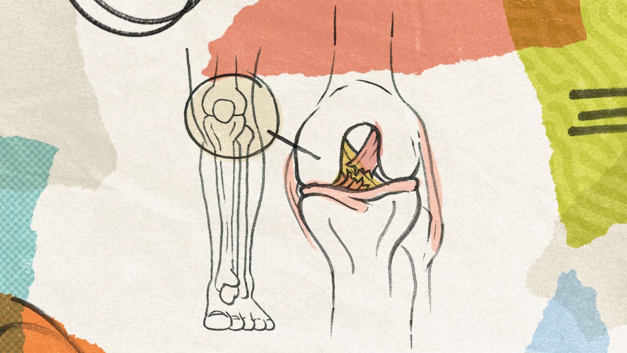 The ACL is one of the key ligaments inside the knee. It joins the thigh bone to the shin bone and keeps the knee stable.