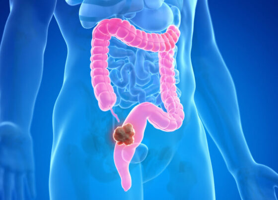 An illustration of a blue person's colon highlighted in pink with a chunk of brown resting in the colon.