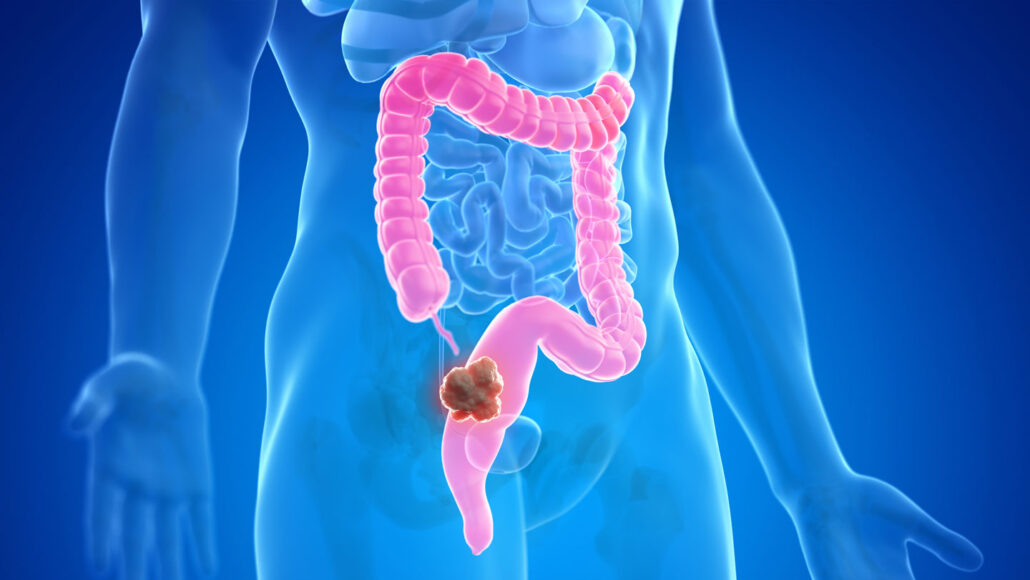 Why are more people under 50 getting colorectal cancer? Scientists have some clues