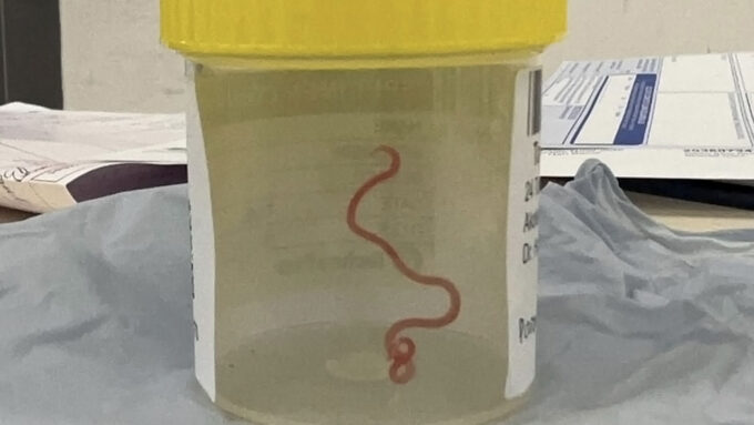 Doctors found a live python parasite in a woman’s brain